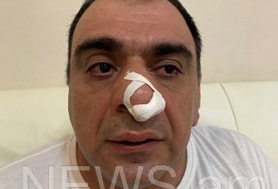 Մոսկվաբնակ գործարարը պնդում է, որ Երևանում Խաչատուր Սուքիասյանի եղբայրն ու թիկնապահն իրեն ծեծի են ենթարկել (ֆոտո)
