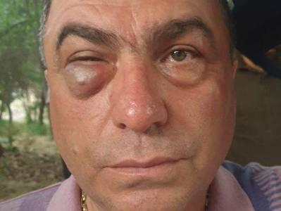 «Հայաստան» դաշինքի ներկայացուցչին ծեծել է բանգլադեշցի Կարենը՝ ոստիկանների հետ միասին